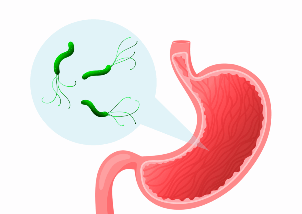 Infección por Helicobacter Pylori
